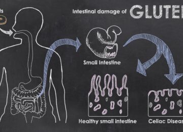 Celiac Disease in Older Adults & Seniors